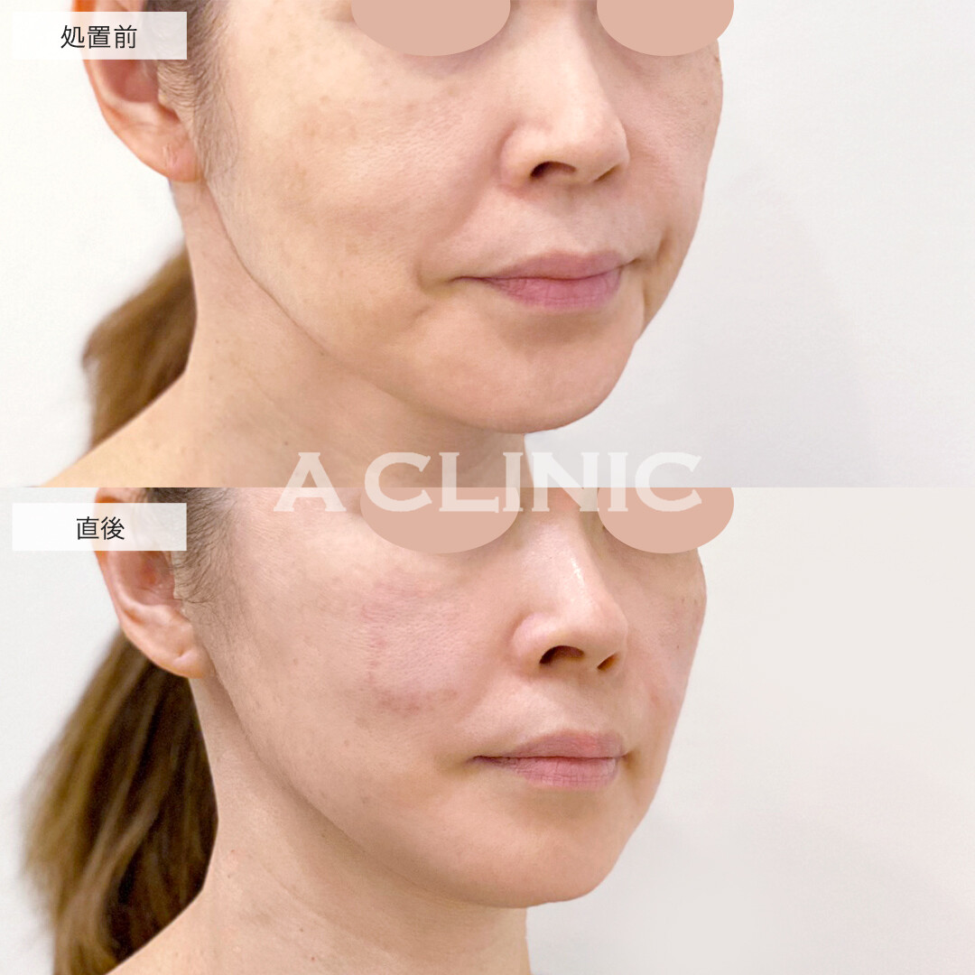 美肌ショッピングリフトで頬のたるみをキュッと引き上げ！処置前と直後の症例です(50代女性)