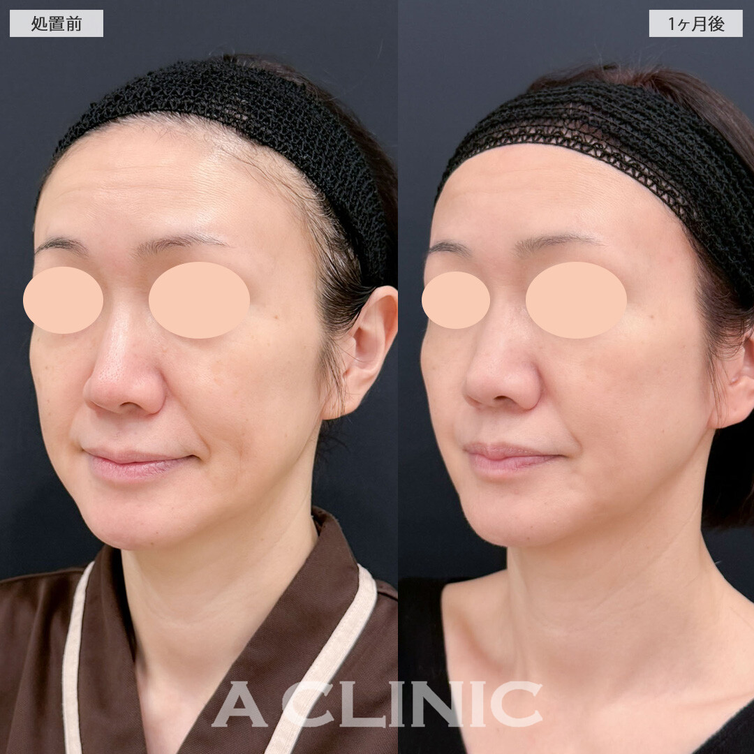 バッカルファット除去術とAスレッドで下がってきた脂肪を無くすことができました！こちら処置前と1ヶ月後の症例です(40代女性)