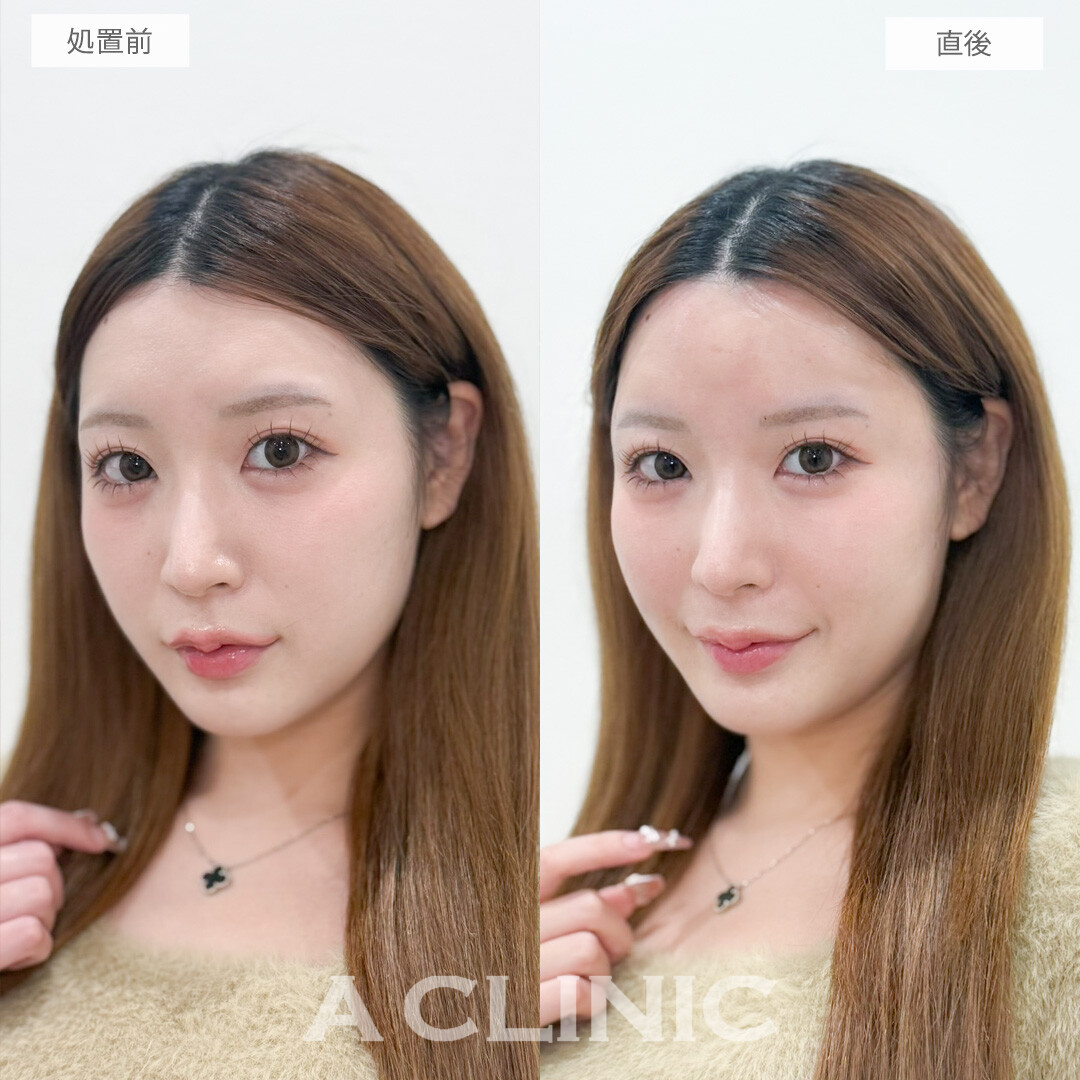 ヒアルロン酸カスタマイズメニューでメリハリのあるお顔で美人度アップ!処置前と直後の症例です(20代女性)