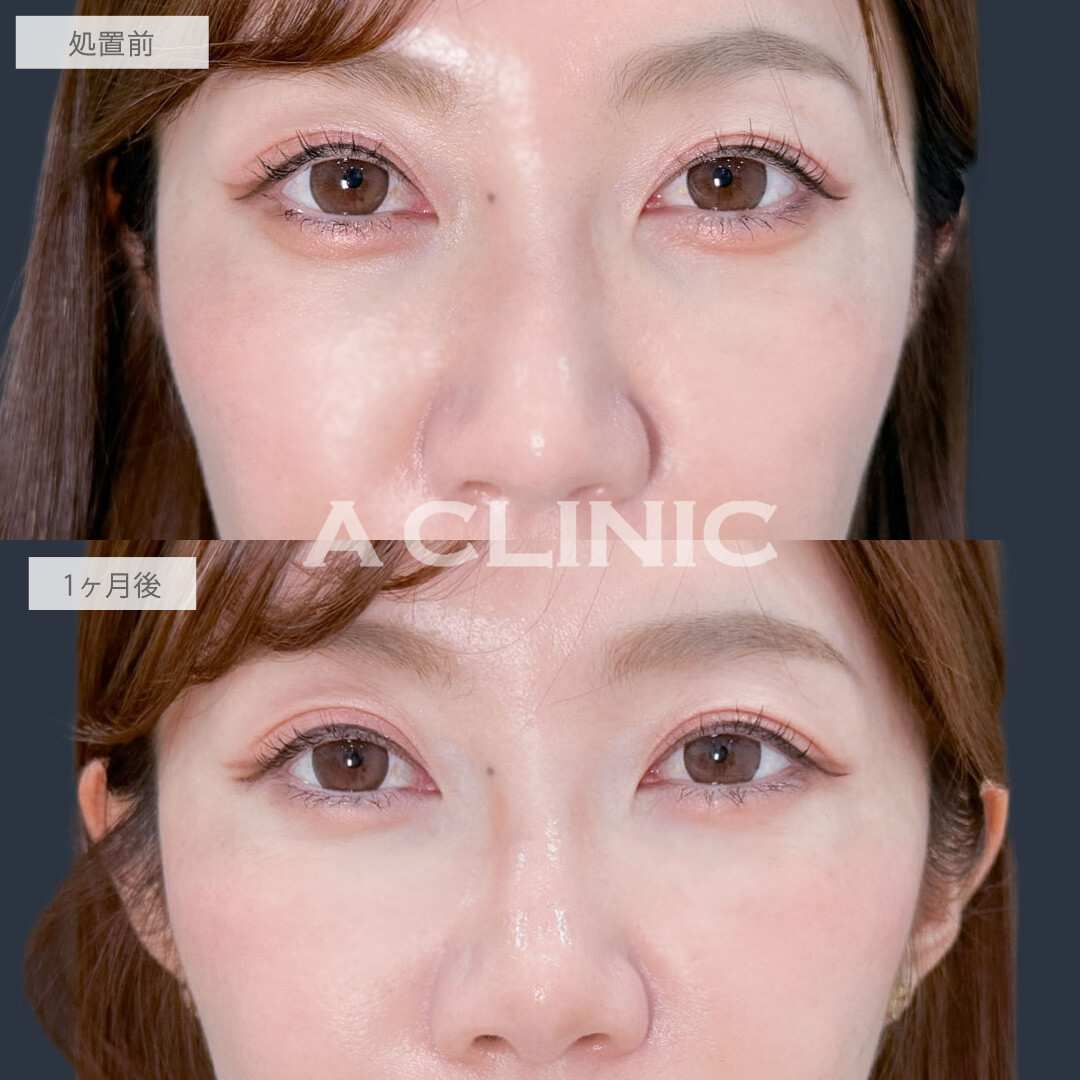 ヒアルロン酸カスタマイズメニューで凹みのお悩み一気に解決！こちら処置前と1ヶ月後の症例です(30代女性)