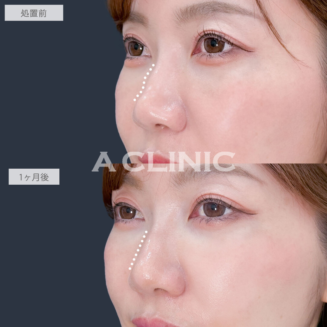 ヒアルロン酸カスタマイズメニューで凹みのお悩み一気に解決！こちら処置前と1ヶ月後の症例です(30代女性)
