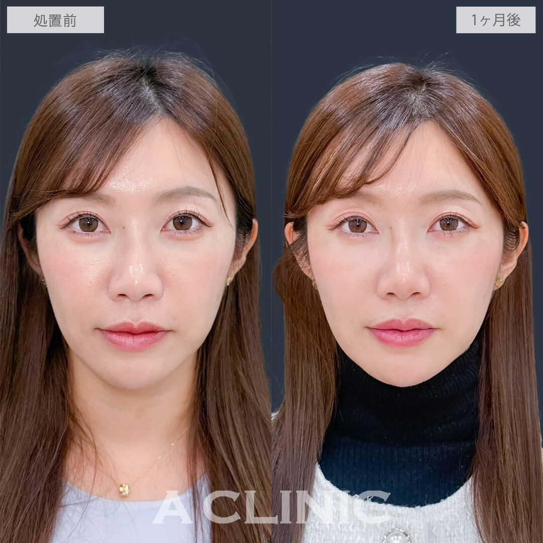 ヒアルロン酸カスタマイズメニューで凹みのお悩み一気に解決！こちら処置前と1ヶ月後の症例です(30代女性)