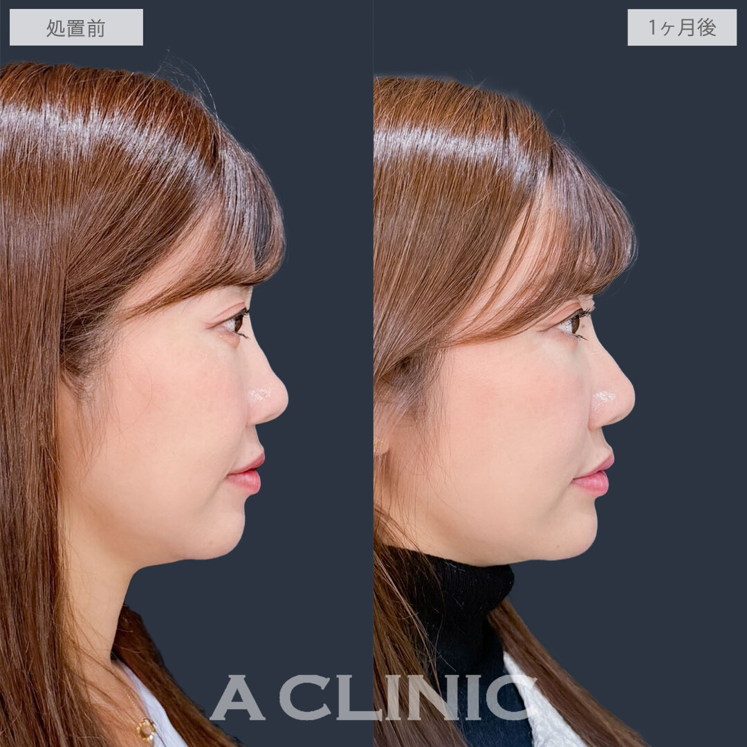 ヒアルロン酸カスタマイズメニューで凹みのお悩み一気に解決！こちら処置前と1ヶ月後の症例です(30代女性)