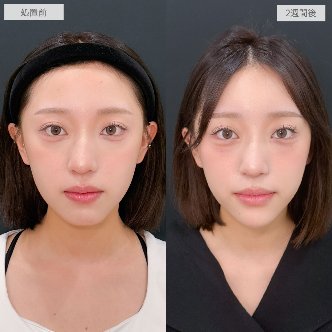 ヒアルロン酸カスタマイズメニューで立体的で魅力あふれるお顔に!こちら処置前と2週間後の症例です(20代女性)