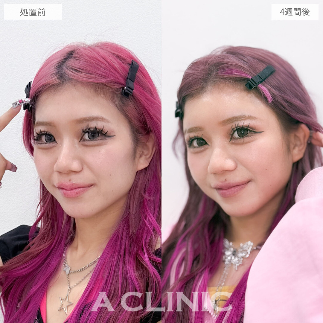 ヒアルロン酸カスタマイズメニューで凹みを埋めて女性らしい印象に！こちら処置前と4週間後の症例です(20代女性)