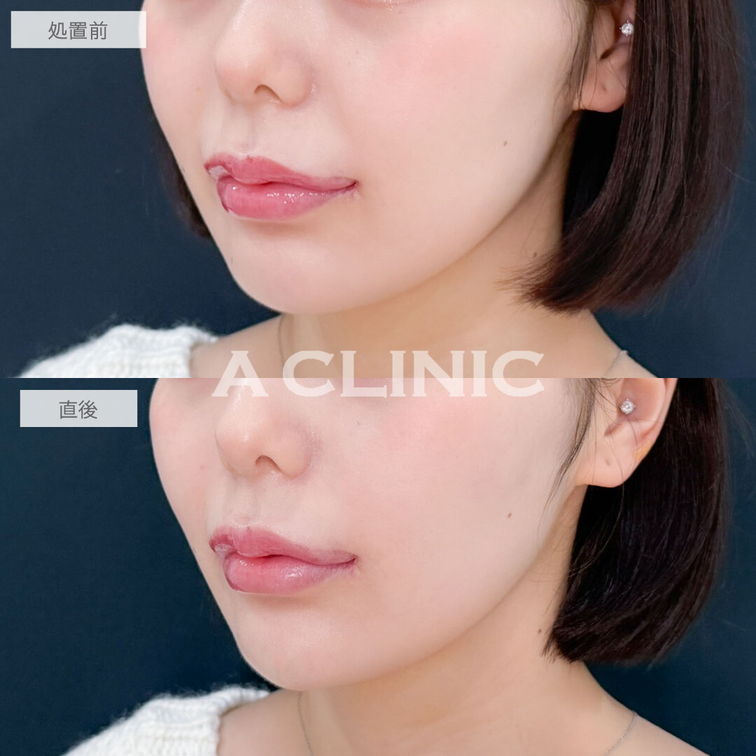 ヒアルロン酸カスタマイズメニューでお顔の凹みを改善させて整った印象になりました！こちら処置前と直後の症例です(20代女性)