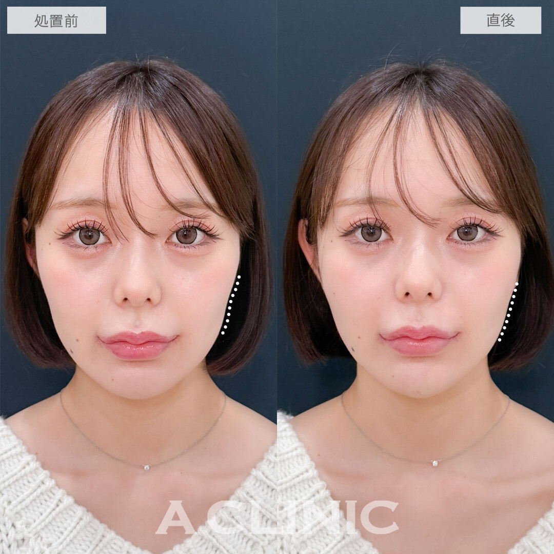 ヒアルロン酸カスタマイズメニューでお顔の凹みを改善させて整った印象になりました！こちら処置前と直後の症例です(20代女性)