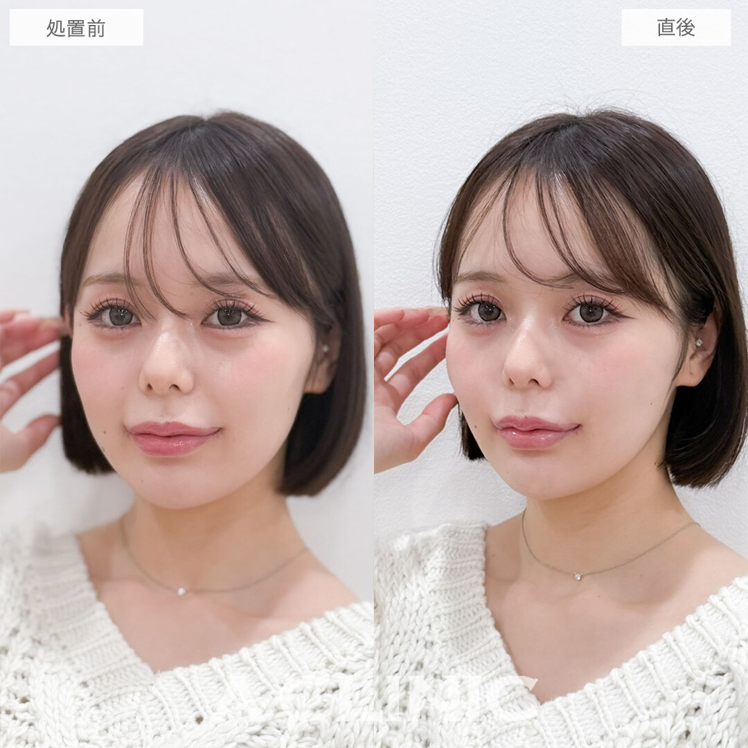 ヒアルロン酸カスタマイズメニューでお顔の凹みを改善させて整った印象になりました！こちら処置前と直後の症例です(20代女性)