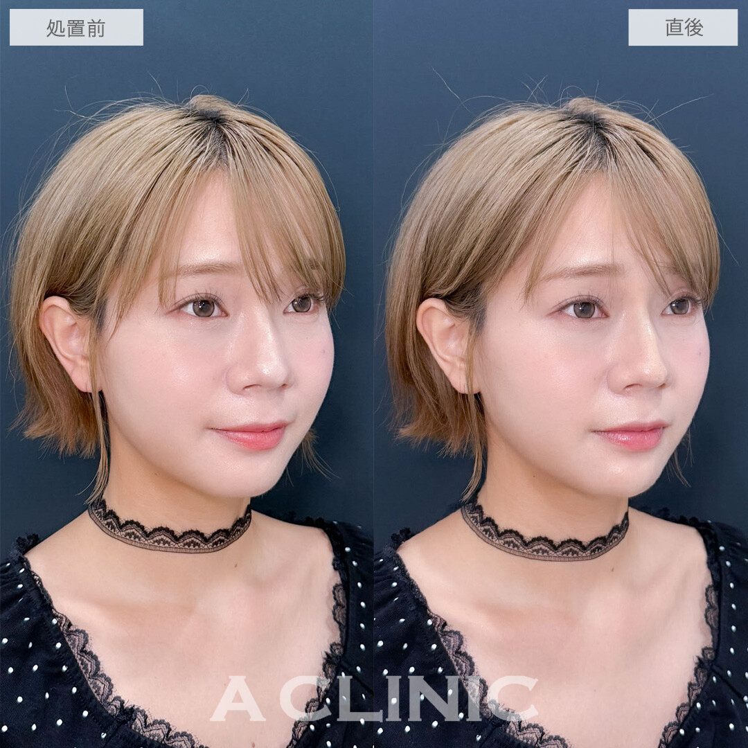 ヒアルロン酸カスタマイズメニューで鼻を高くしアゴの形も整えました!こちら処置前と直後の症例です(30代女性)