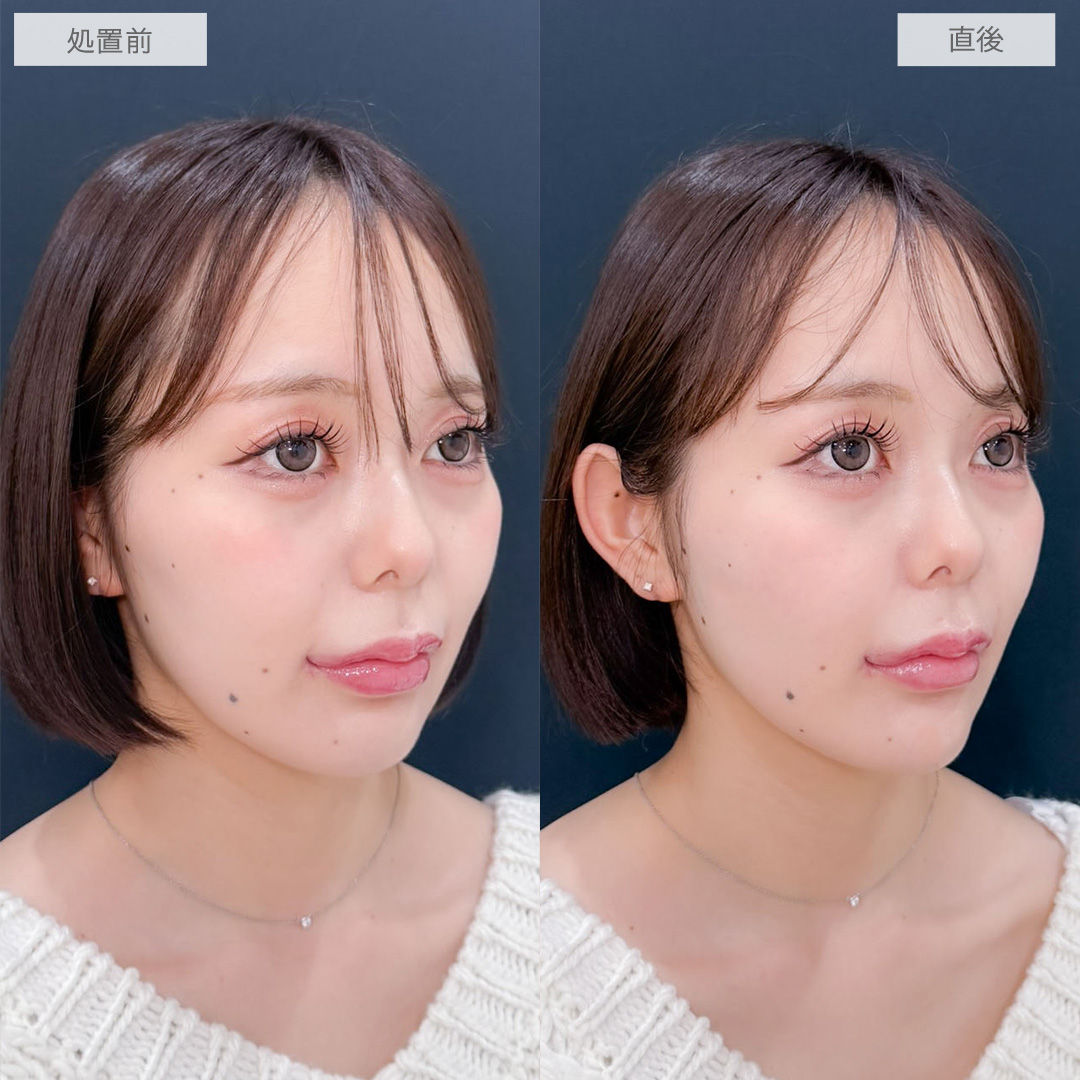 ヒアルロン酸カスタマイズメニューでお顔の凹みを改善させて整った印象になりました！こちら処置前と直後の症例です(20代女性)