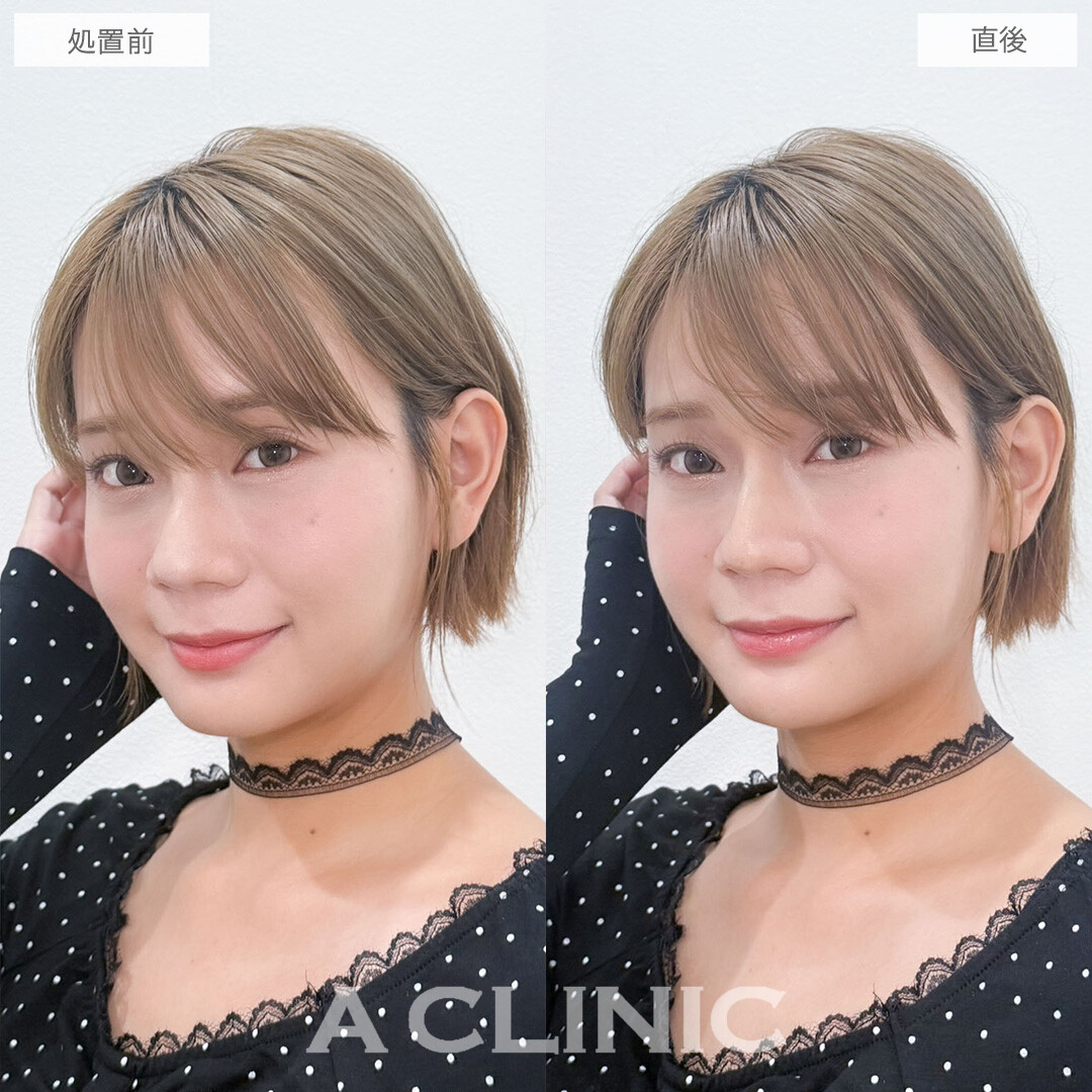 ヒアルロン酸カスタマイズメニューで鼻を高くしアゴの形も整えました!こちら処置前と直後の症例です(30代女性)