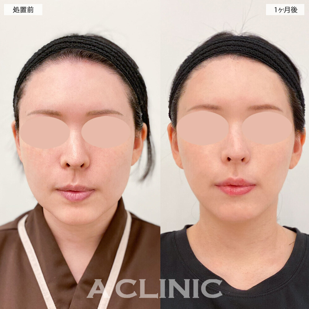 1day小顔脂肪吸引と小顔エラボトックスでスッキリ輪郭が整いました！こちら処置前から2ヶ月後の症例です(30代女性)