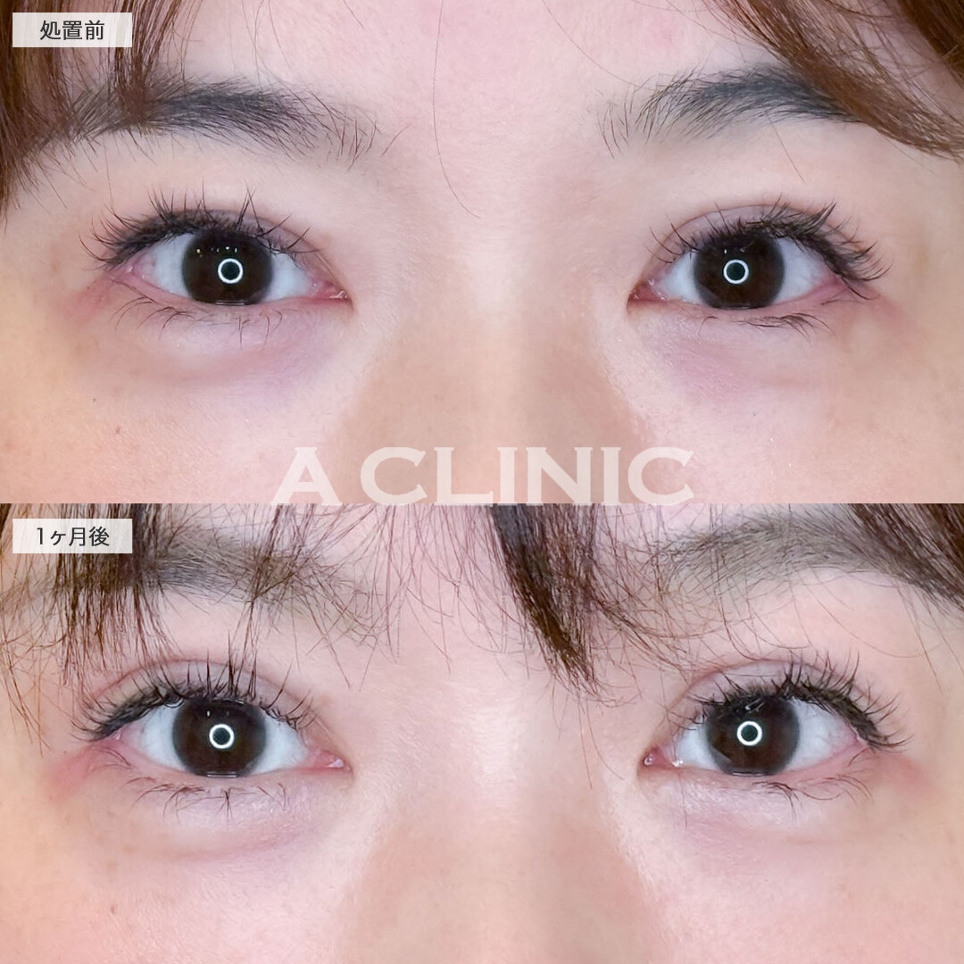 二重術埋没法で二重にかぶさっていたたるみ感を改善！こちら処置前と1ヶ月後の症例です(30代女性)