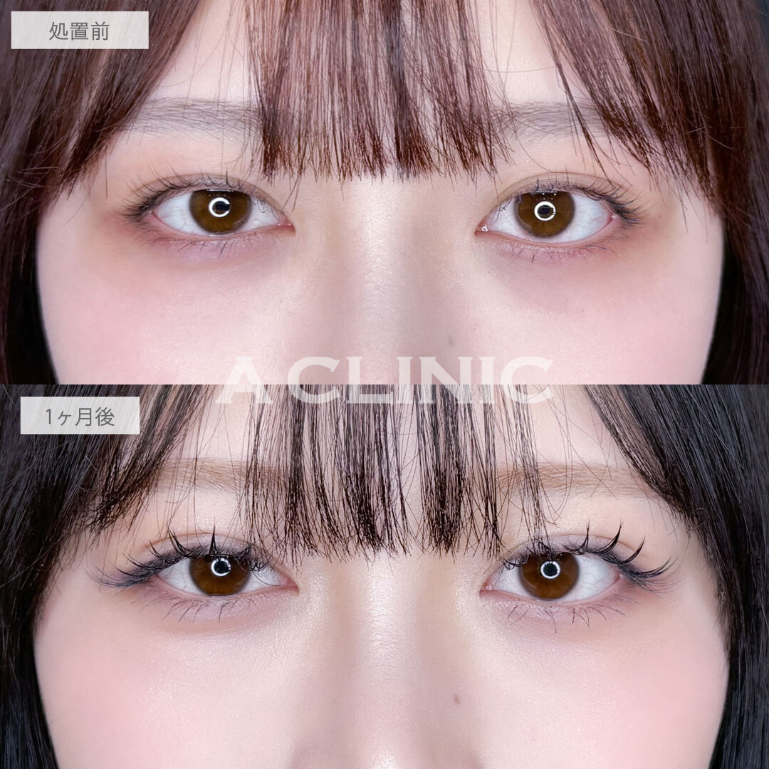 二重術埋没法で左右差を整えぱっちりきれいな二重になりました!こちら処置前と1ヶ月後の症例です(20代女性)