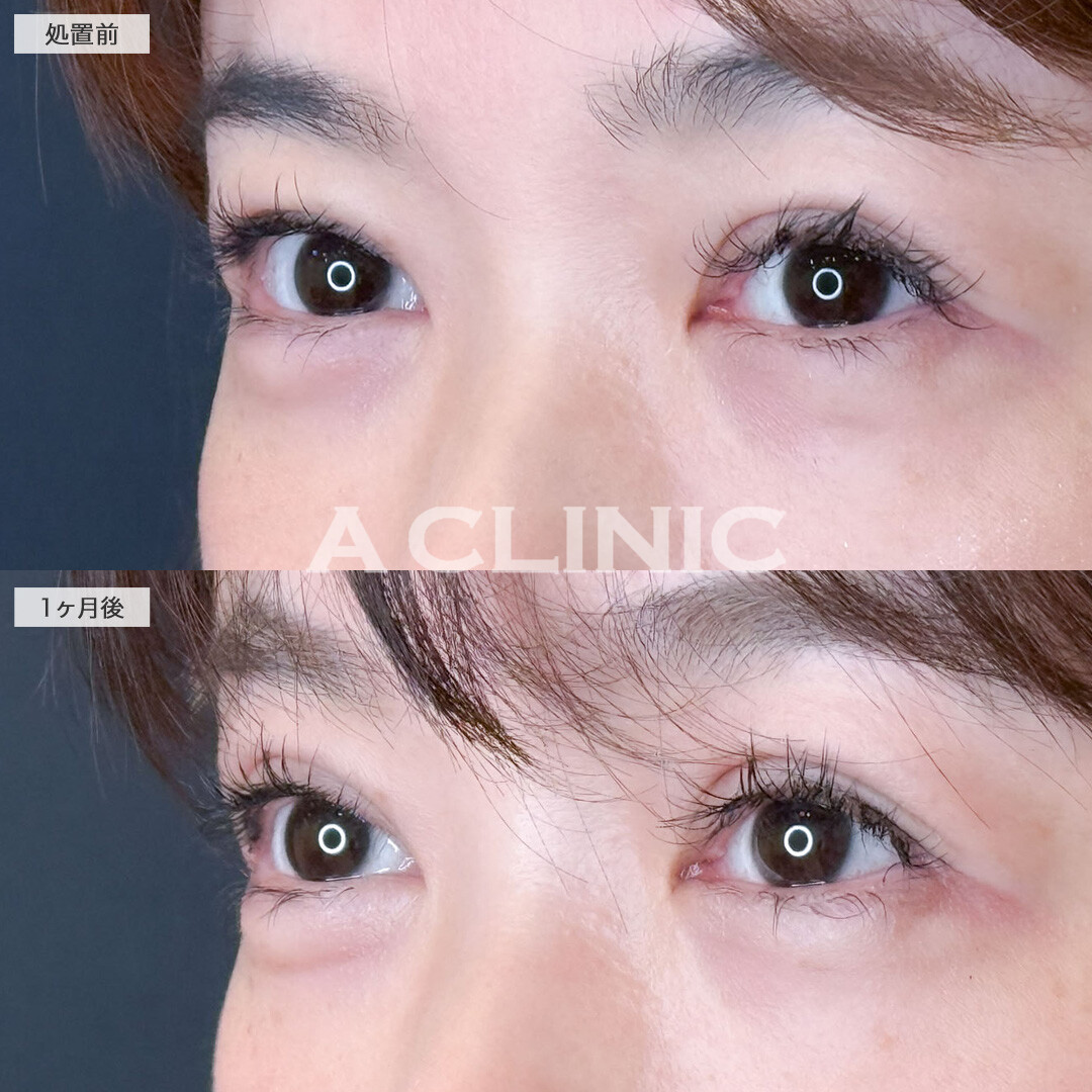 二重術埋没法で二重にかぶさっていたたるみ感を改善！こちら処置前と1ヶ月後の症例です(30代女性)