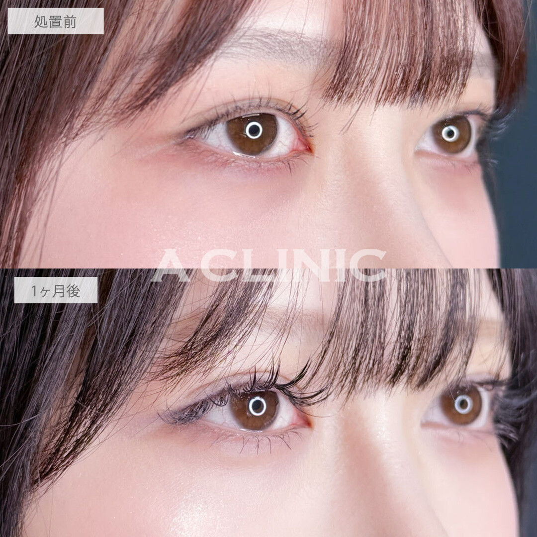 二重術埋没法で左右差を整えぱっちりきれいな二重になりました!こちら処置前と1ヶ月後の症例です(20代女性)