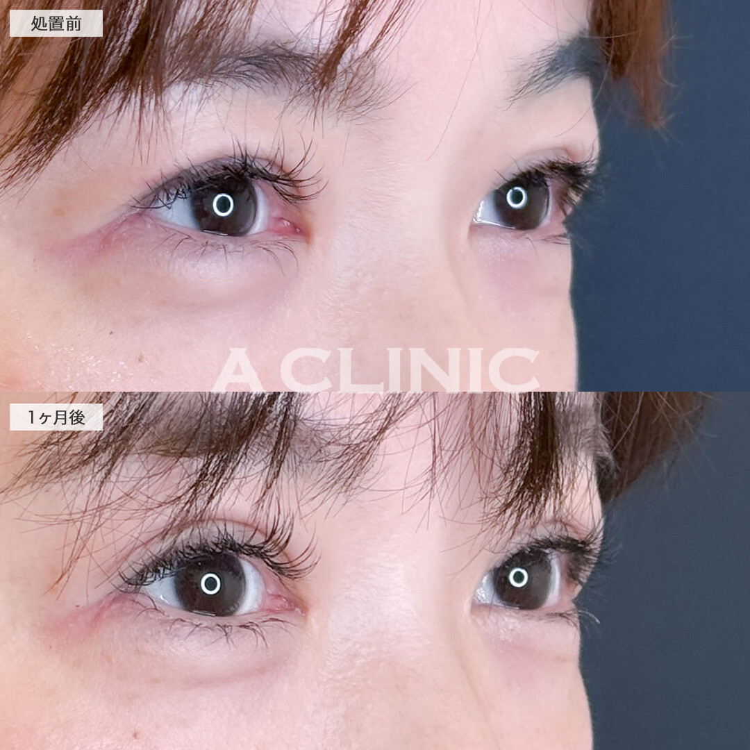 二重術埋没法で二重にかぶさっていたたるみ感を改善！こちら処置前と1ヶ月後の症例です(30代女性)