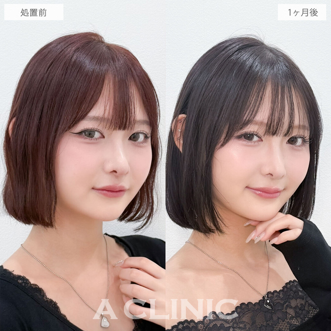 二重術埋没法で左右差を整えぱっちりきれいな二重になりました!こちら処置前と1ヶ月後の症例です(20代女性)