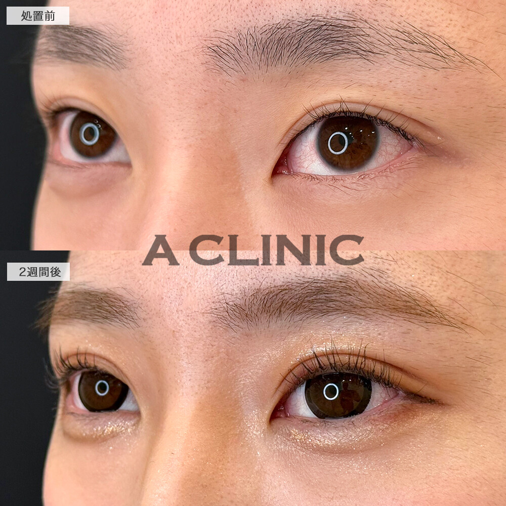 二重術埋没法で左右差が改善し、アイプチも卒業！処置前から2週間後の症例です(20代女性)