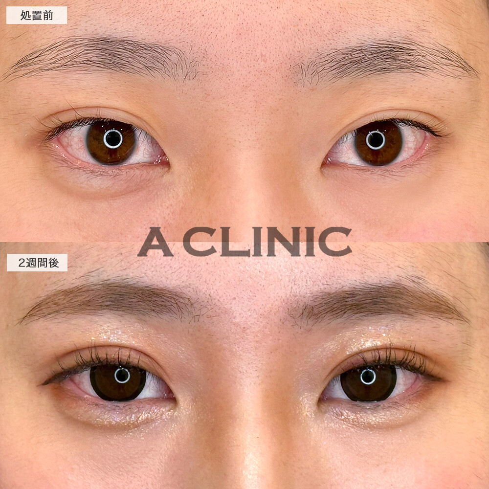 二重術埋没法で左右差が改善し、アイプチも卒業！処置前から2週間後の症例です(20代女性)
