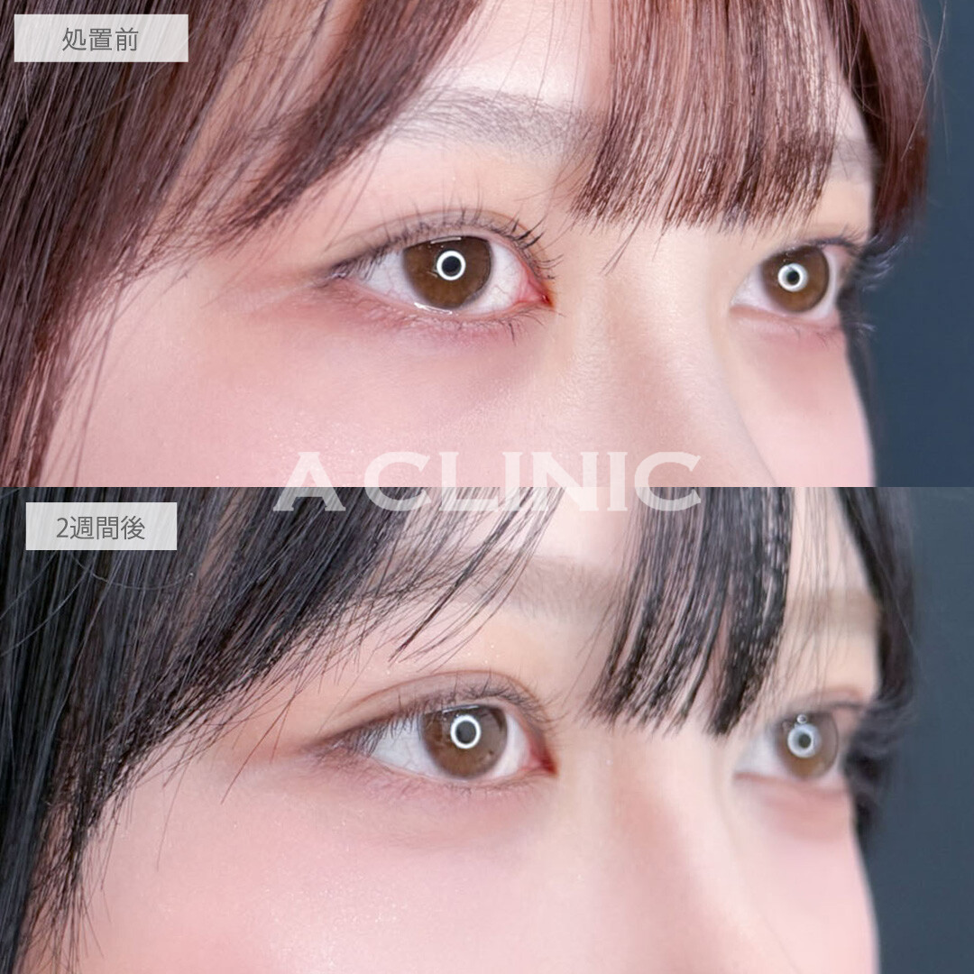 二重術埋没法で左右差が無くなりさらに印象的な目元に!こちら処置前と2週間後の症例です(20代女性)