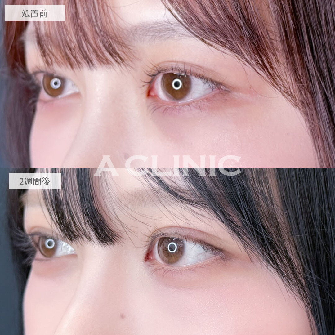 二重術埋没法で左右差が無くなりさらに印象的な目元に!こちら処置前と2週間後の症例です(20代女性)