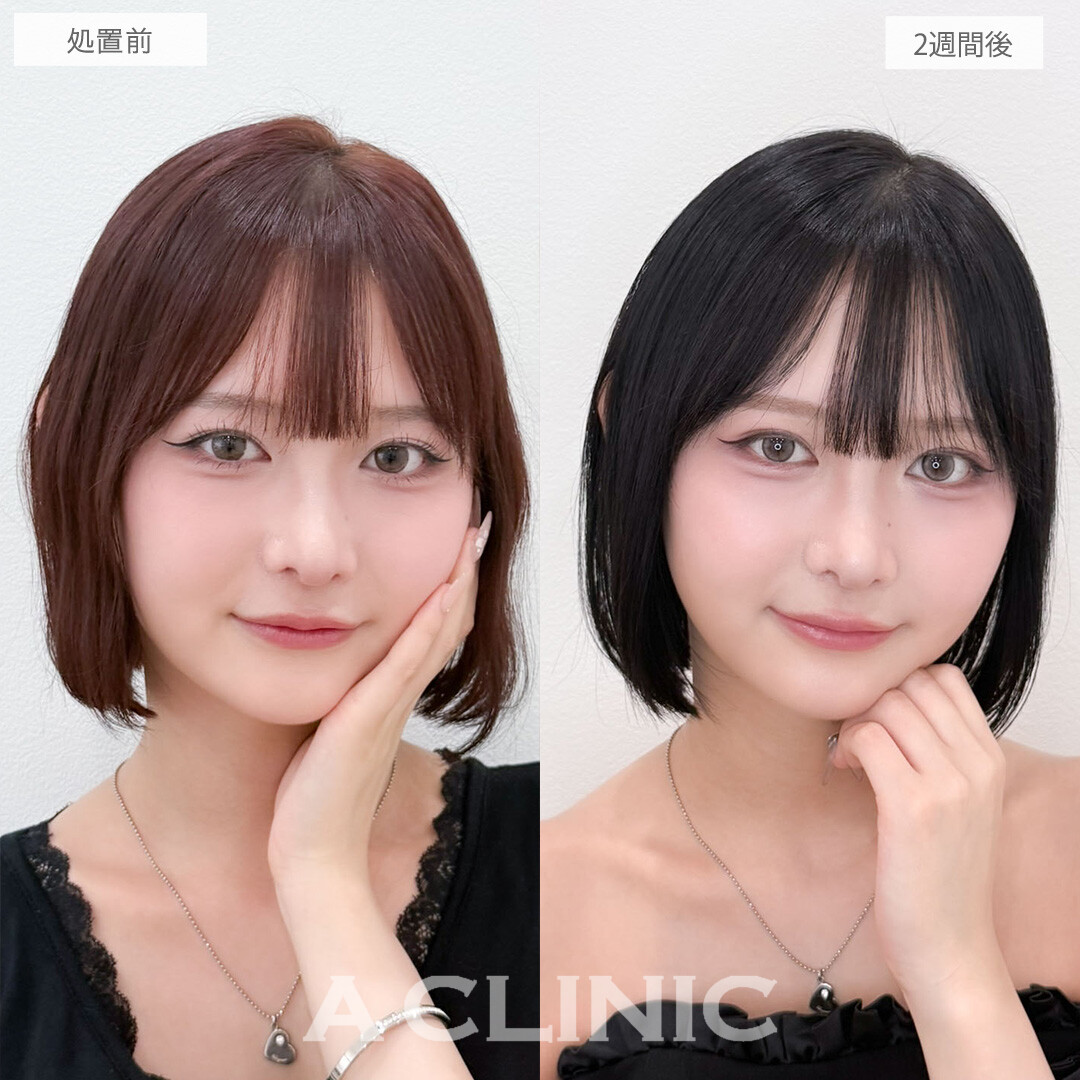 二重術埋没法で左右差が無くなりさらに印象的な目元に!こちら処置前と2週間後の症例です(20代女性)