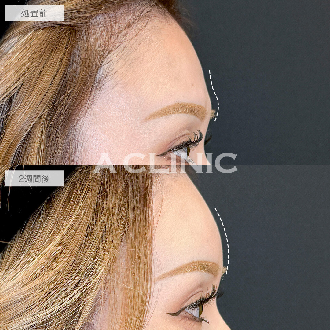 ヒアルロン酸カスタマイズメニューで自信を持って写真が撮れるようになりました！処置前と2週間後の症例です(20代女性)