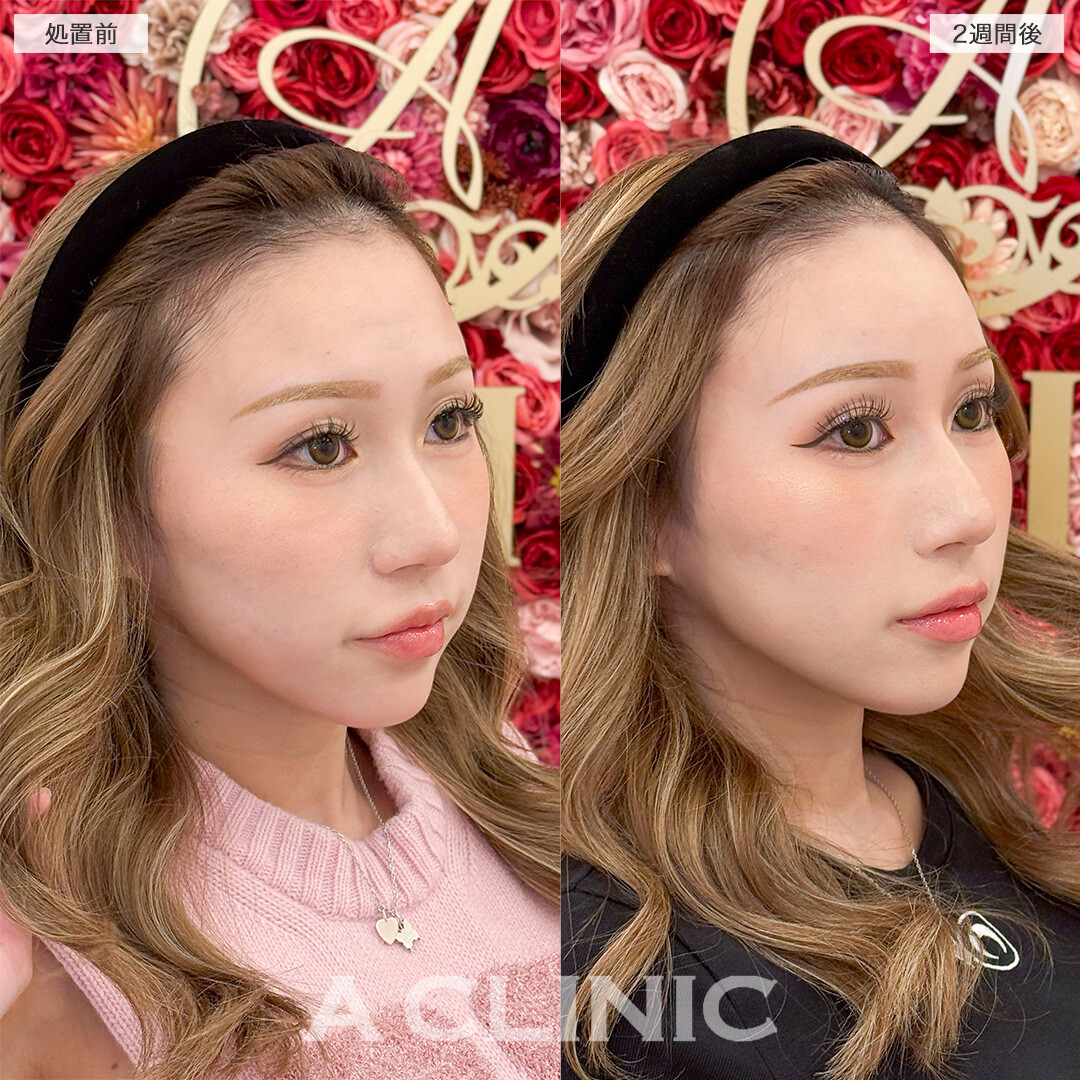 ヒアルロン酸カスタマイズメニューで自信を持って写真が撮れるようになりました！処置前と2週間後の症例です(20代女性)