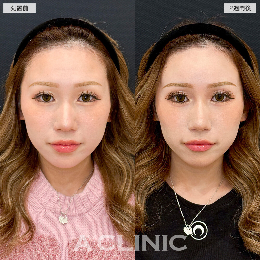 ヒアルロン酸カスタマイズメニューで自信を持って写真が撮れるようになりました！処置前と2週間後の症例です(20代女性)