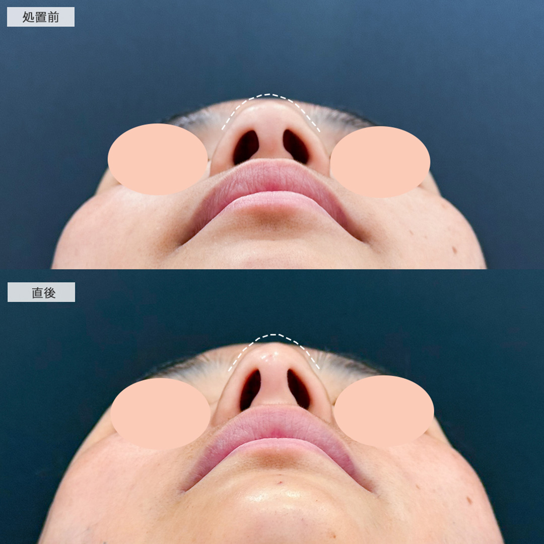 1day小顔脂肪吸引とヒアルロン酸カスタマイズメニューで脂肪とたるみにアプローチしヒアルロン酸で足し算の自然若返り術！こちら処置前と直後の症例です(40代女性)