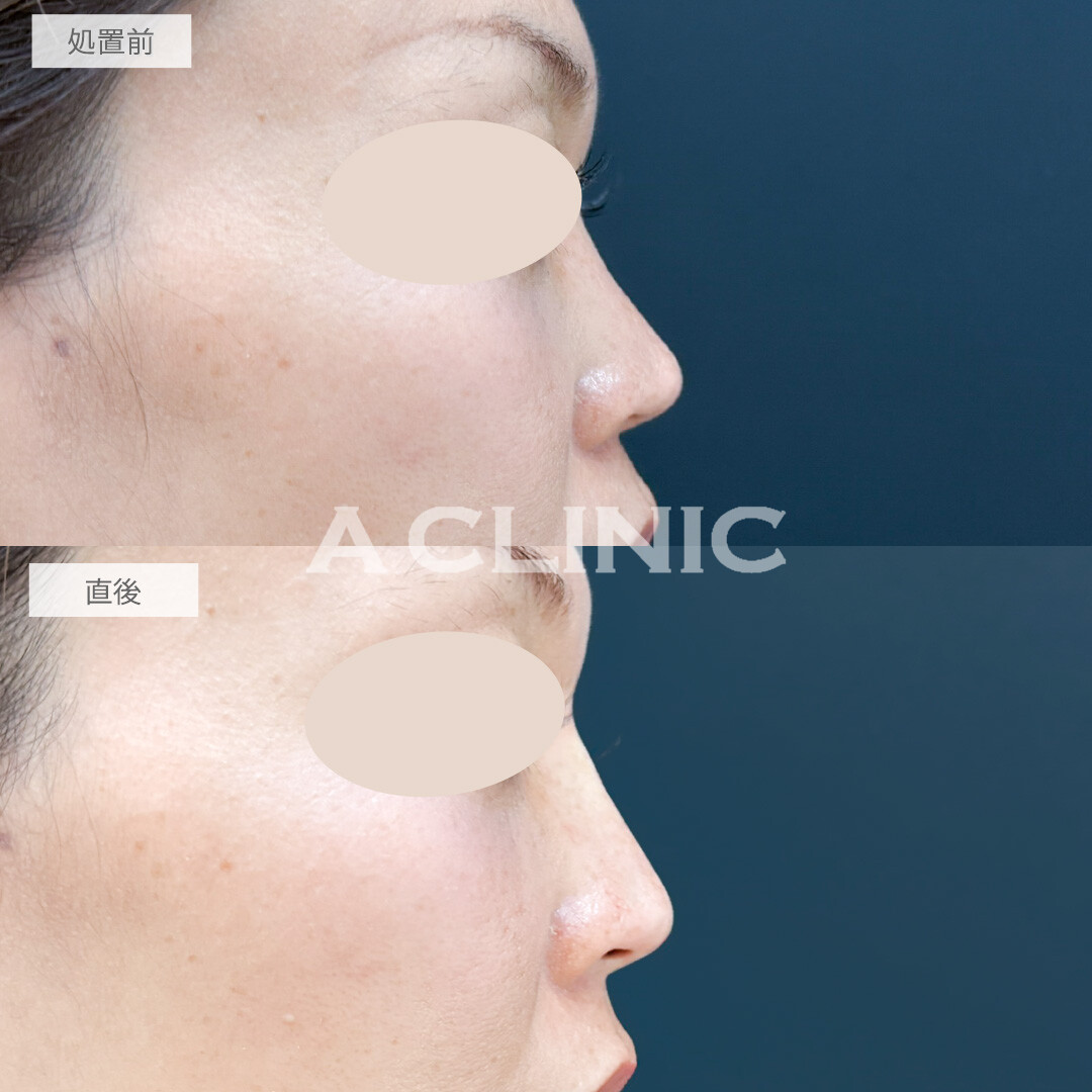 ジャスミンノーズで自分に似合う鼻を先生に提案してもらえました！処置前と直後の症例です(30代女性)