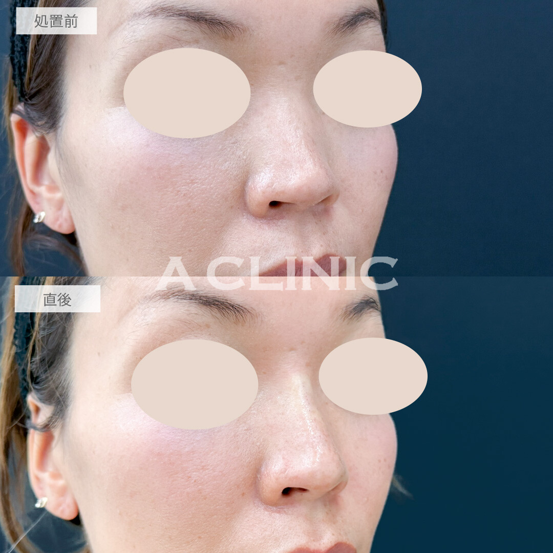 ジャスミンノーズで自分に似合う鼻を先生に提案してもらえました！処置前と直後の症例です(30代女性)