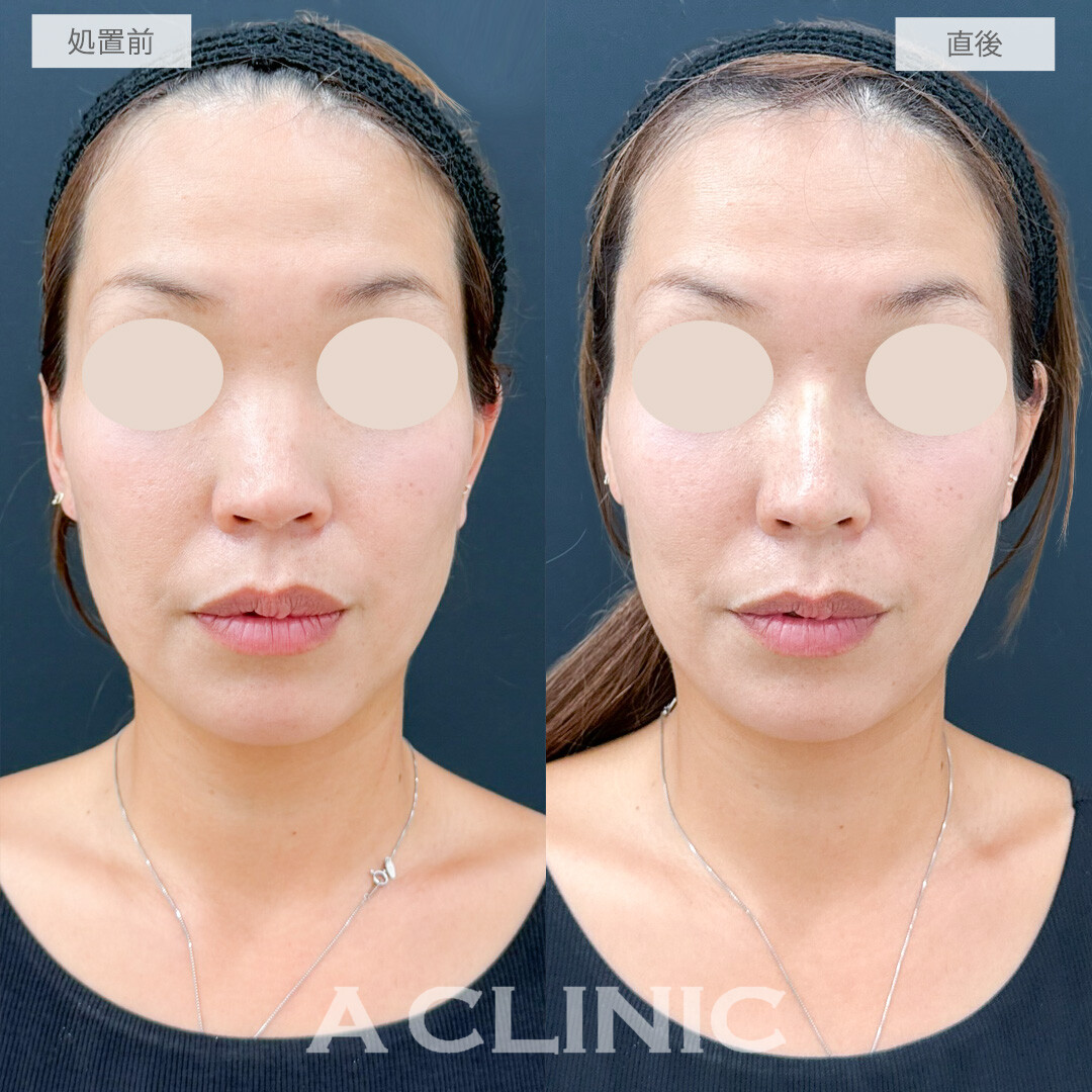 ジャスミンノーズで自分に似合う鼻を先生に提案してもらえました！処置前と直後の症例です(30代女性)