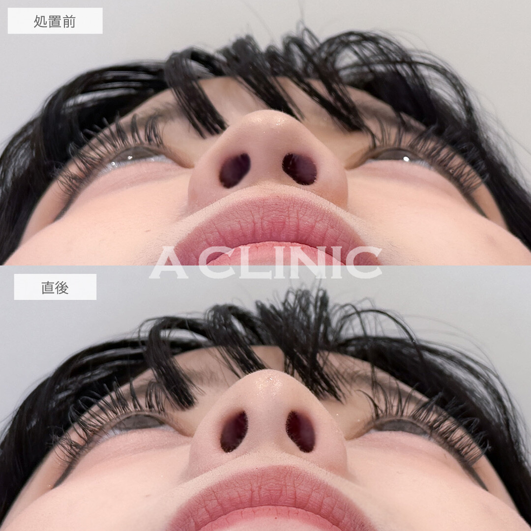 ジャスミンノーズで鼻筋を通して高さも出ました！こちら処置前と直後の症例です(20代女性)