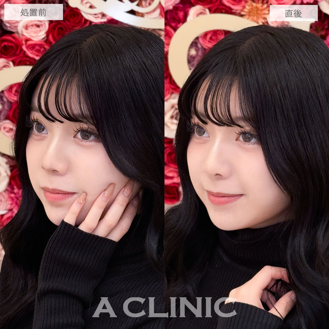 ジャスミンノーズで鼻筋を通して高さも出ました！こちら処置前と直後の症例です(20代女性)