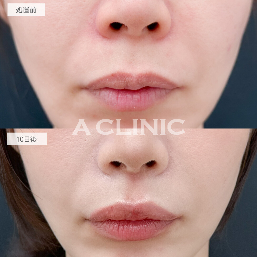切らない人中短縮(Cカール形成術)で老け顔改善し可愛らしい印象になりました！処置前と10日後の症例です(30代女性)