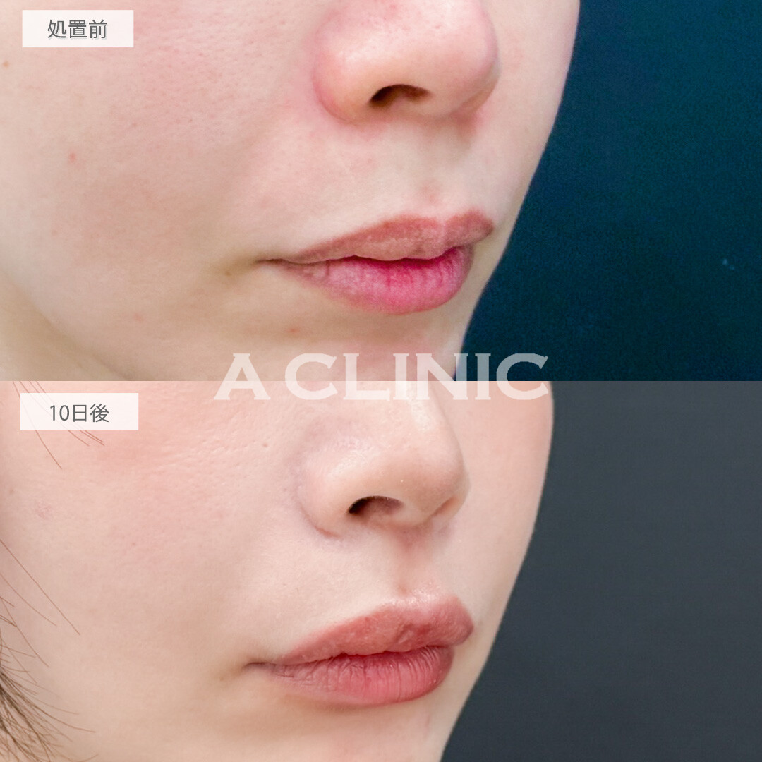 切らない人中短縮(Cカール形成術)で老け顔改善し可愛らしい印象になりました！処置前と10日後の症例です(30代女性)