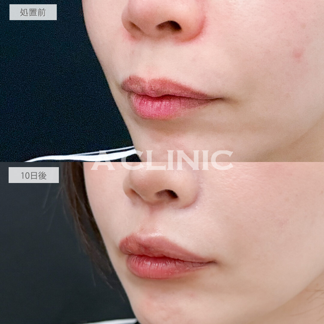 切らない人中短縮(Cカール形成術)で老け顔改善し可愛らしい印象になりました！処置前と10日後の症例です(30代女性)
