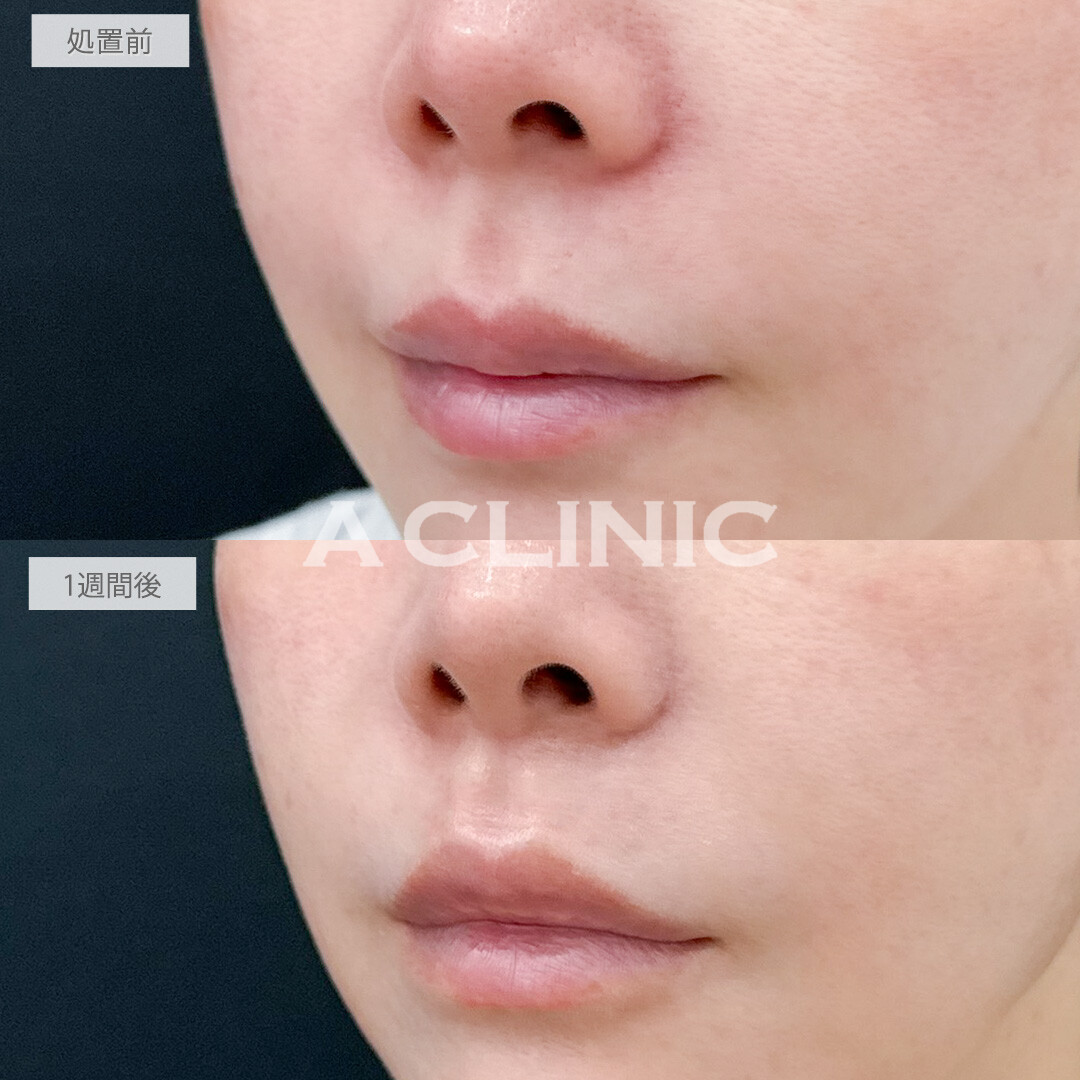 切らない人中短縮(Cカール形成術)で中顔面短縮し若見え！処置前と1週間後の症例です(30代女性)