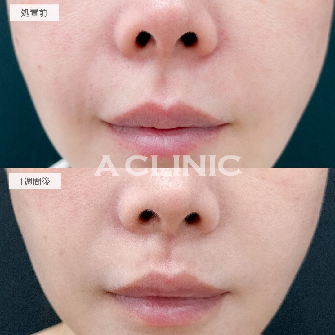 切らない人中短縮(Cカール形成術)で中顔面短縮し若見え！処置前と1週間後の症例です(30代女性)