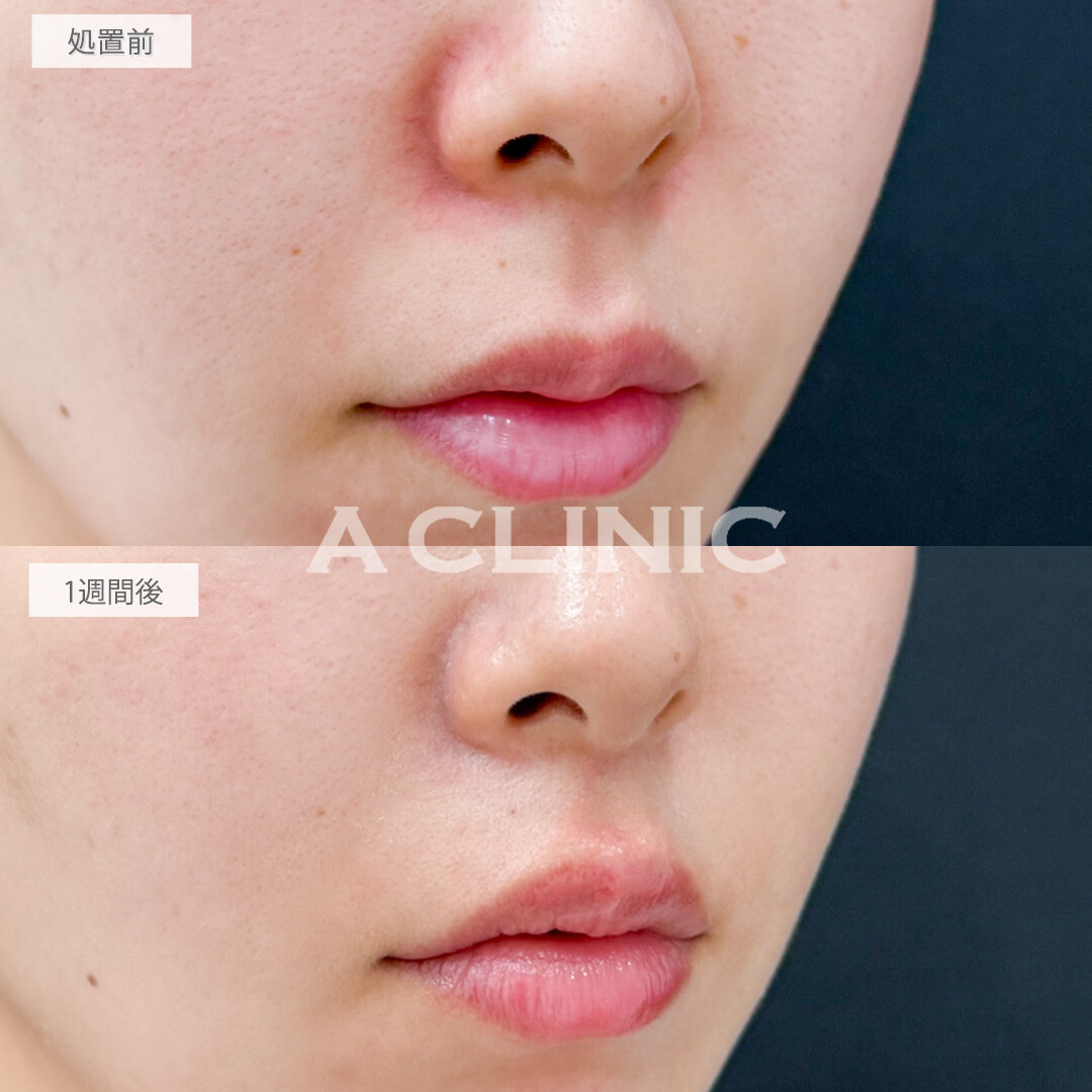 切らない人中短縮(Cカール形成術)で口元を一気に可愛く見せれます！処置前と1週間後の症例です(20代女性)
