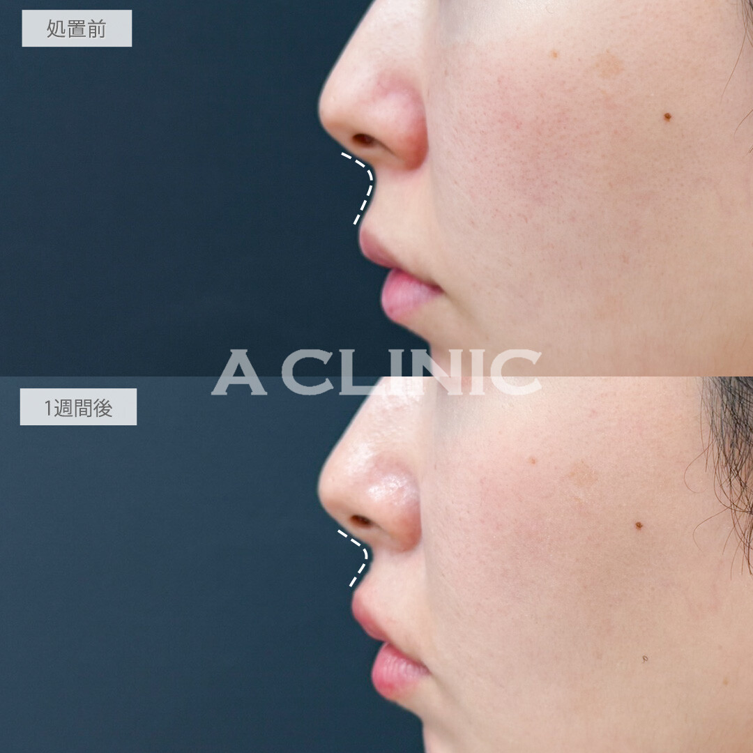 切らない人中短縮(Cカール形成術)で口元を一気に可愛く見せれます！処置前と1週間後の症例です(20代女性)