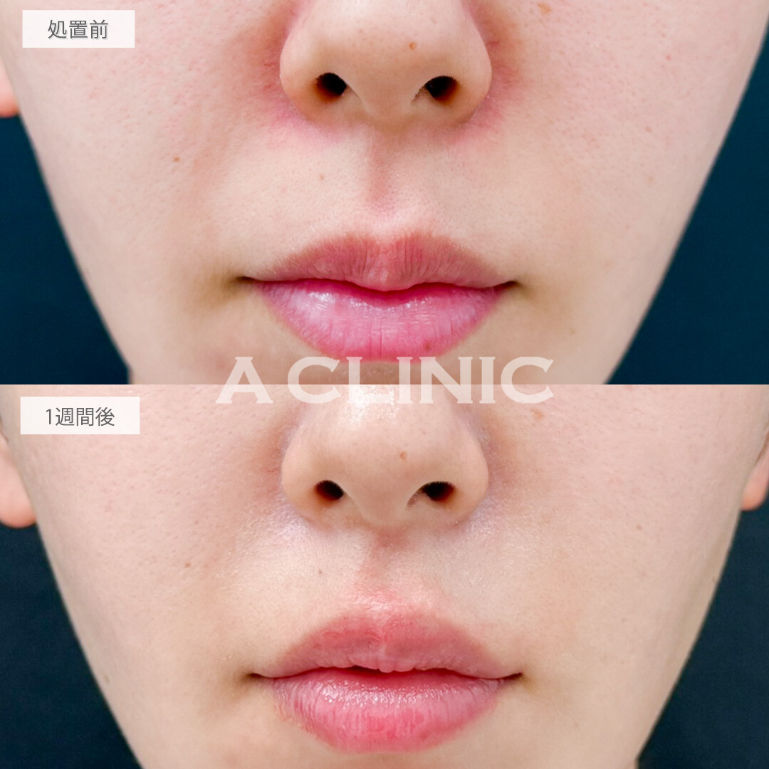 切らない人中短縮(Cカール形成術)で口元を一気に可愛く見せれます！処置前と1週間後の症例です(20代女性)