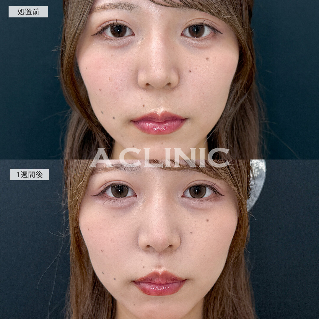 人中が短くなってCカールが形成されることでお顔全体のバランスが整いました！切らない人中短縮(Cカール形成術)の処置前と1週間後の症例です(20代女性)