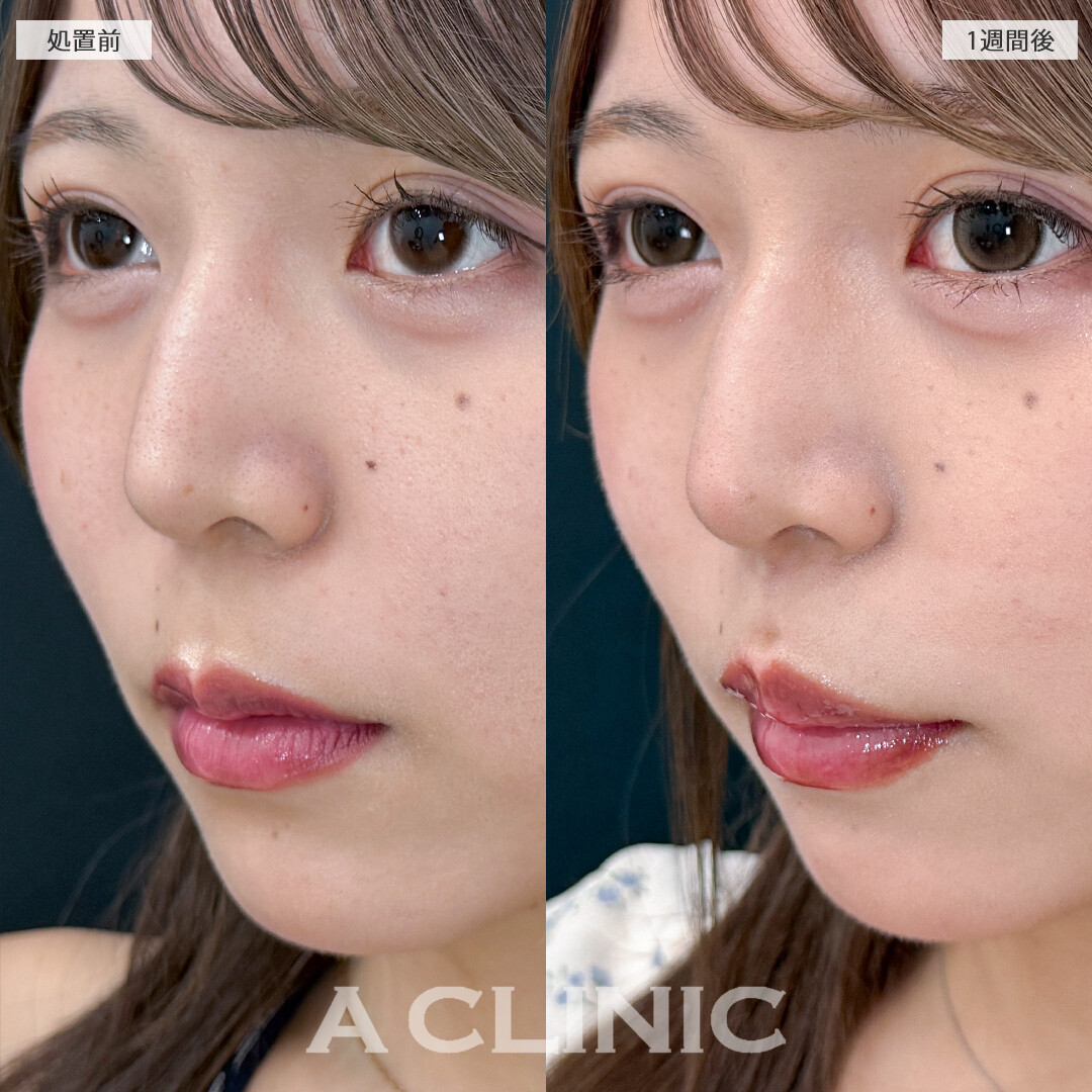 人中が短くなってCカールが形成されることでお顔全体のバランスが整いました！切らない人中短縮(Cカール形成術)の処置前と1週間後の症例です(20代女性)