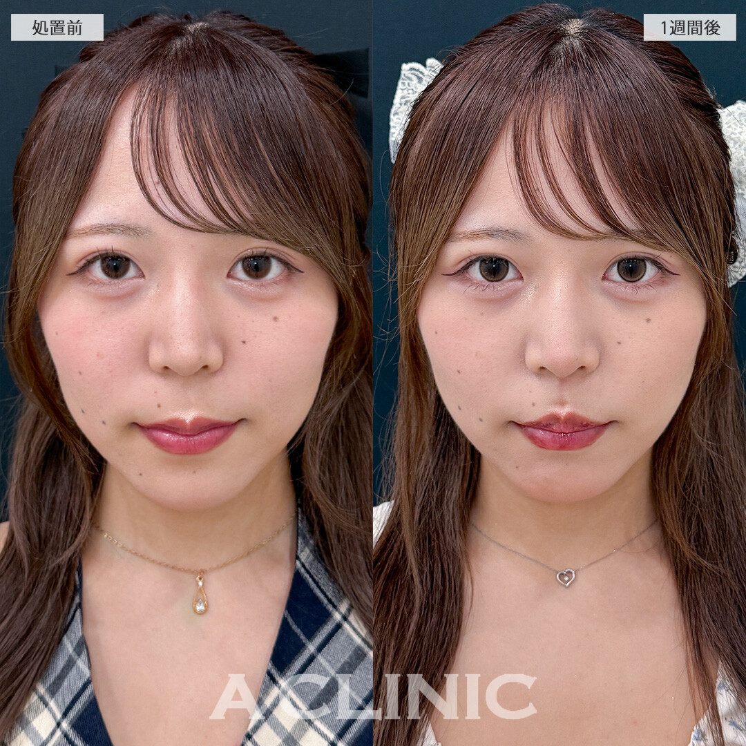 人中が短くなってCカールが形成されることでお顔全体のバランスが整いました！切らない人中短縮(Cカール形成術)の処置前と1週間後の症例です(20代女性)