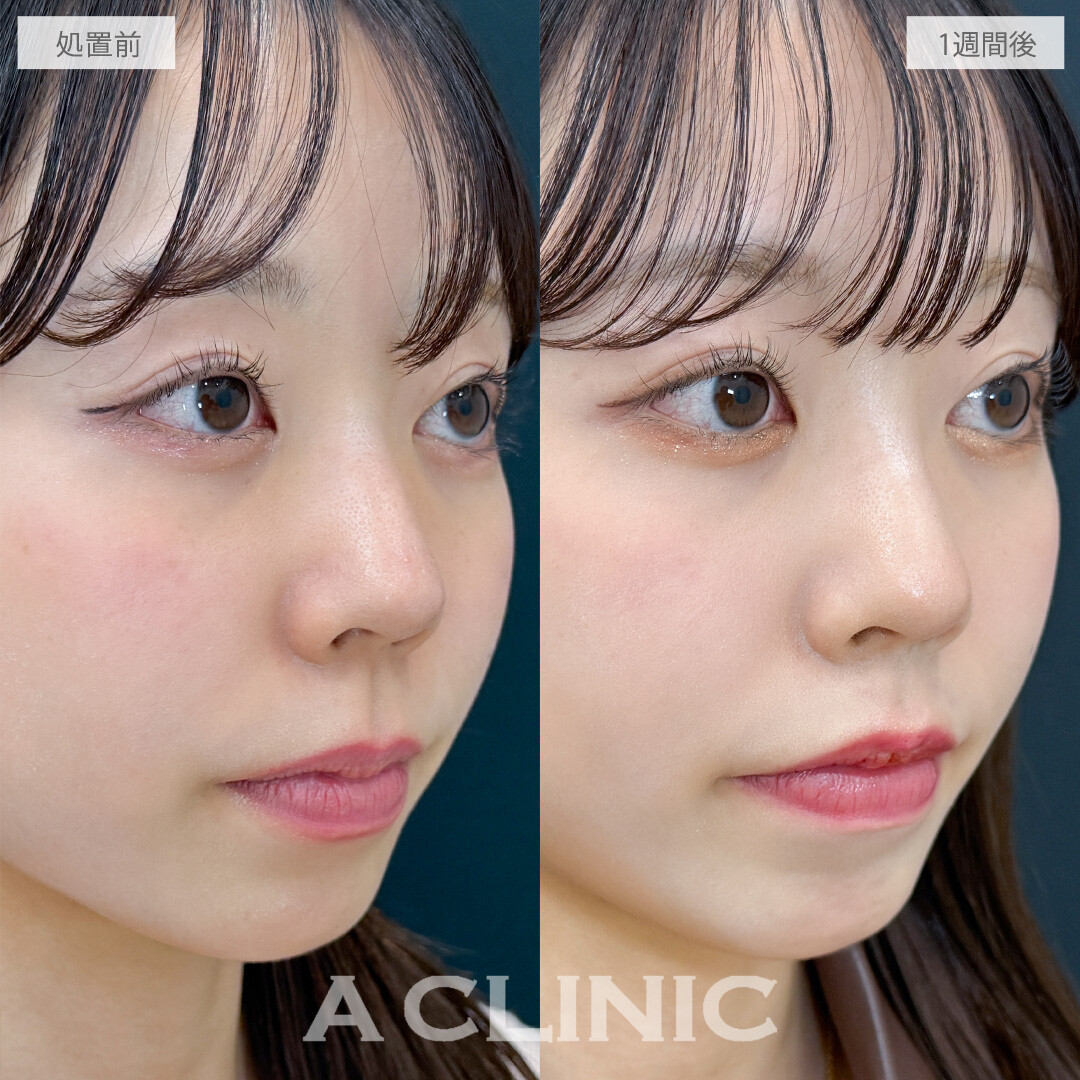 切開しないから長期でお休みが取れなくても安心！切らない人中短縮の処置前と1週間後の症例です(20代女性)