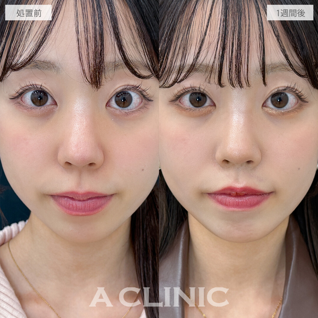 切開しないから長期でお休みが取れなくても安心！切らない人中短縮の処置前と1週間後の症例です(20代女性)