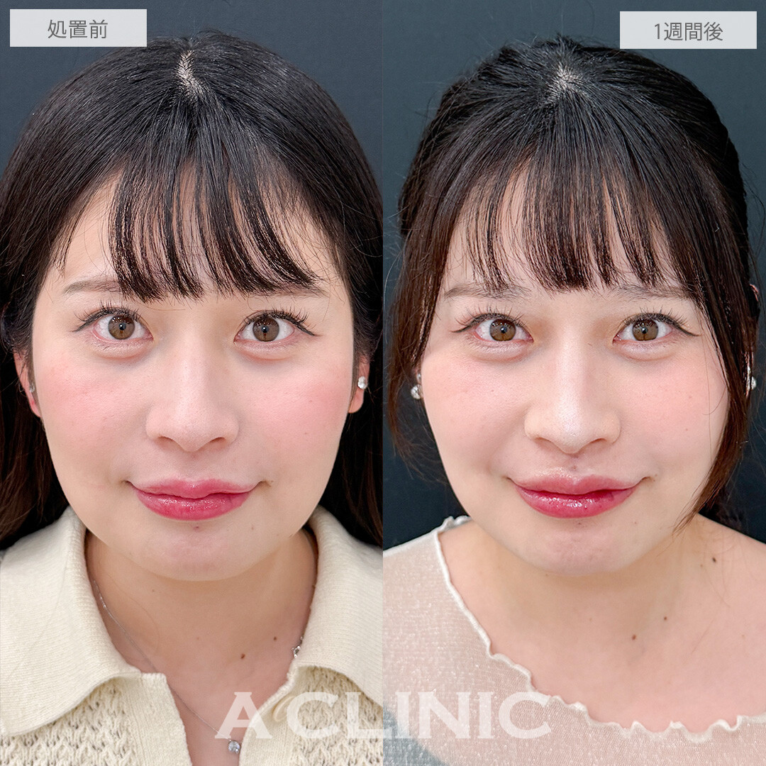 切らない人中短縮(Cカール形成術)なら腫れ等のダウンタイムが最小限!こちら処置前と1週間後の症例です(30代女性)